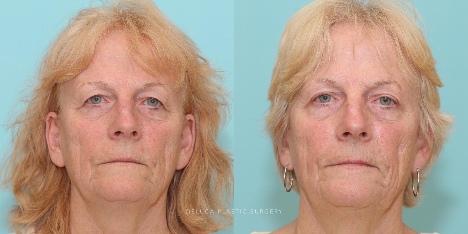 69 year old Upper Eyelid Blepharoplasty