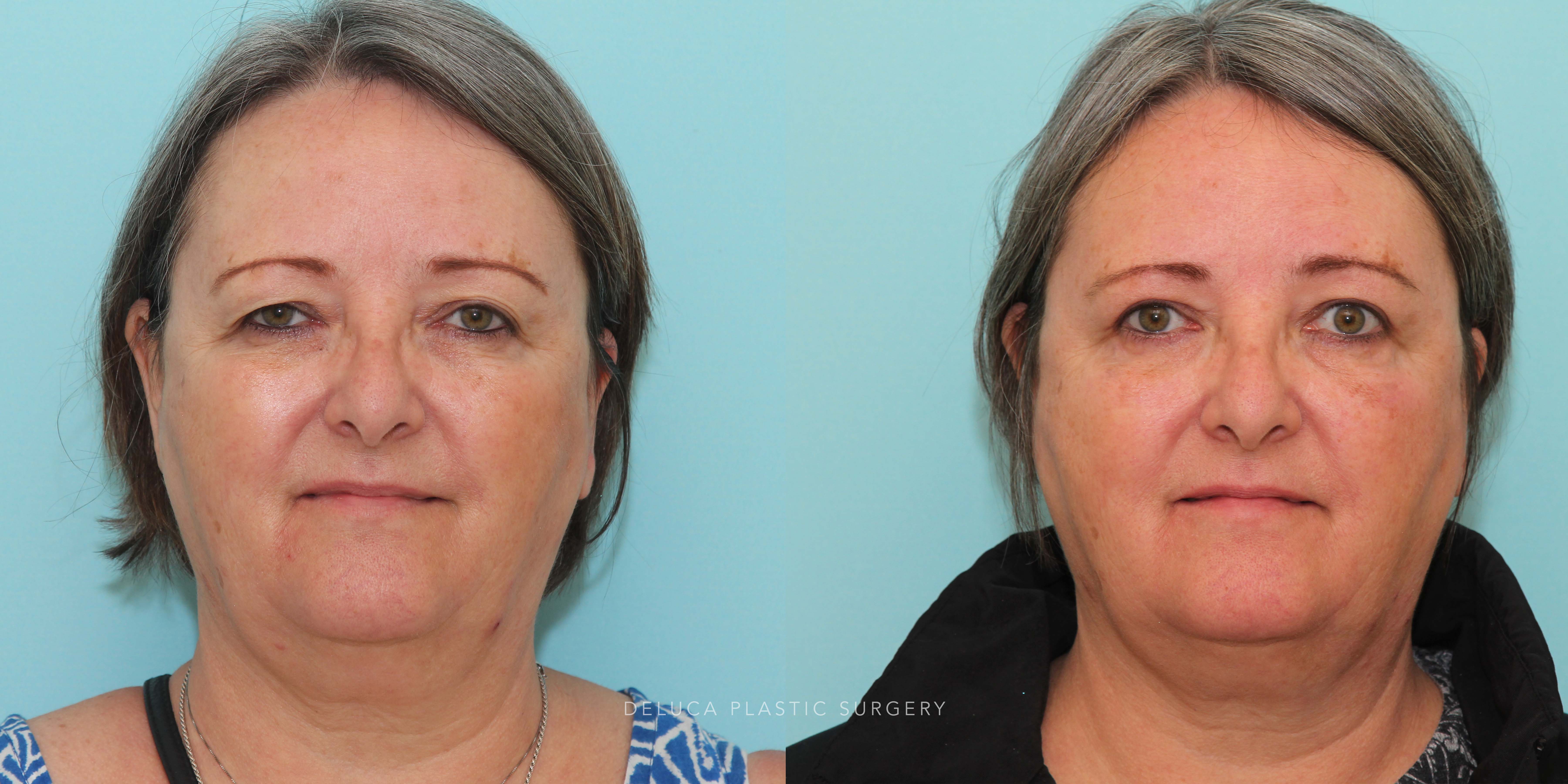 63 year old Upper Lid Blepharoplasty