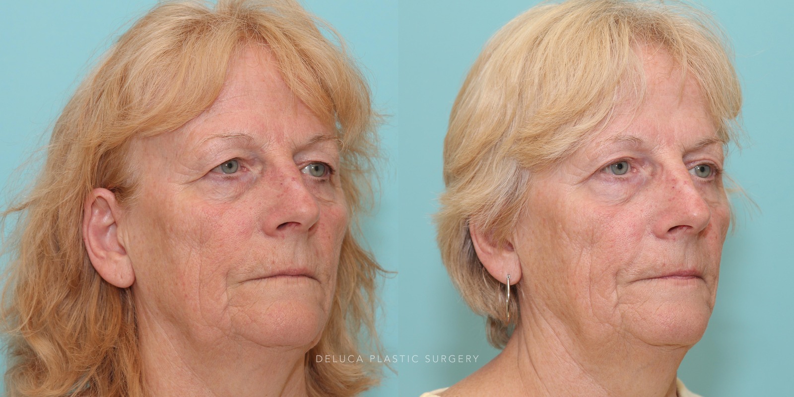 69 year old Upper Eyelid Blepharoplasty