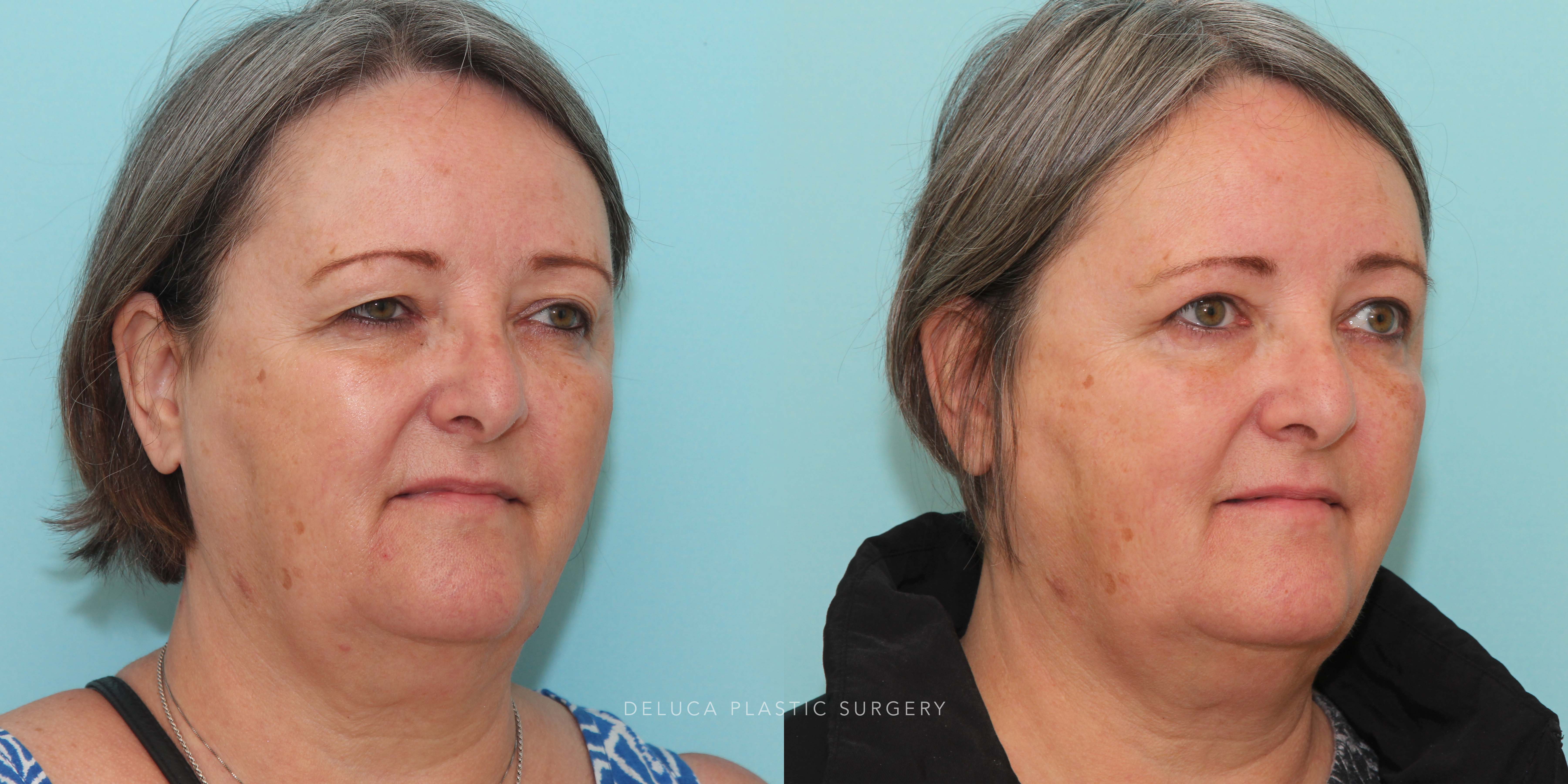 63 year old Upper Lid Blepharoplasty