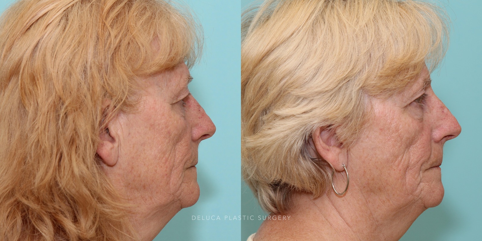 69 year old Upper Eyelid Blepharoplasty