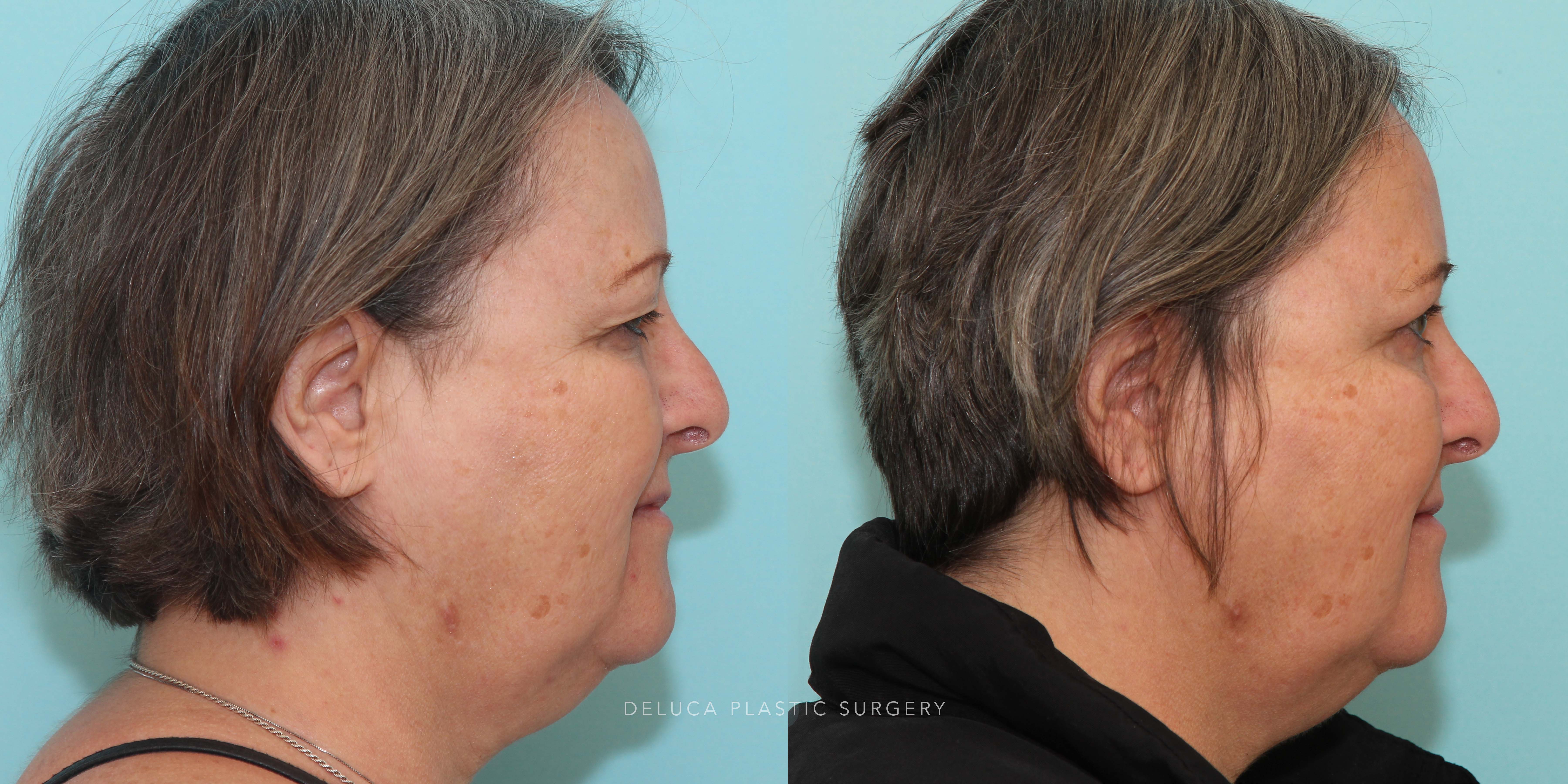 63 year old Upper Lid Blepharoplasty