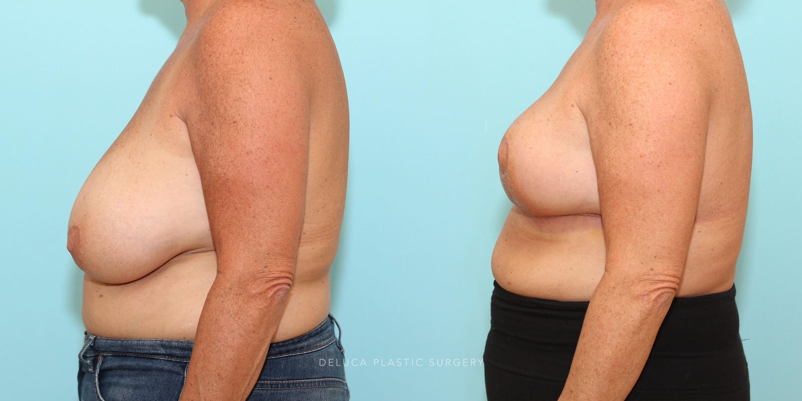 53 year old Inferior Pedicle, Wise Pattern Breast Reduction