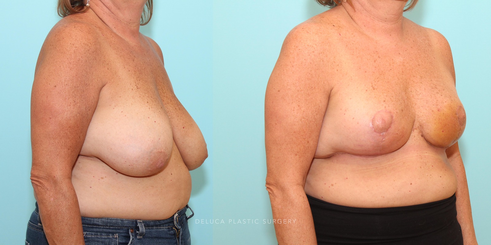 53 year old Inferior Pedicle, Wise Pattern Breast Reduction