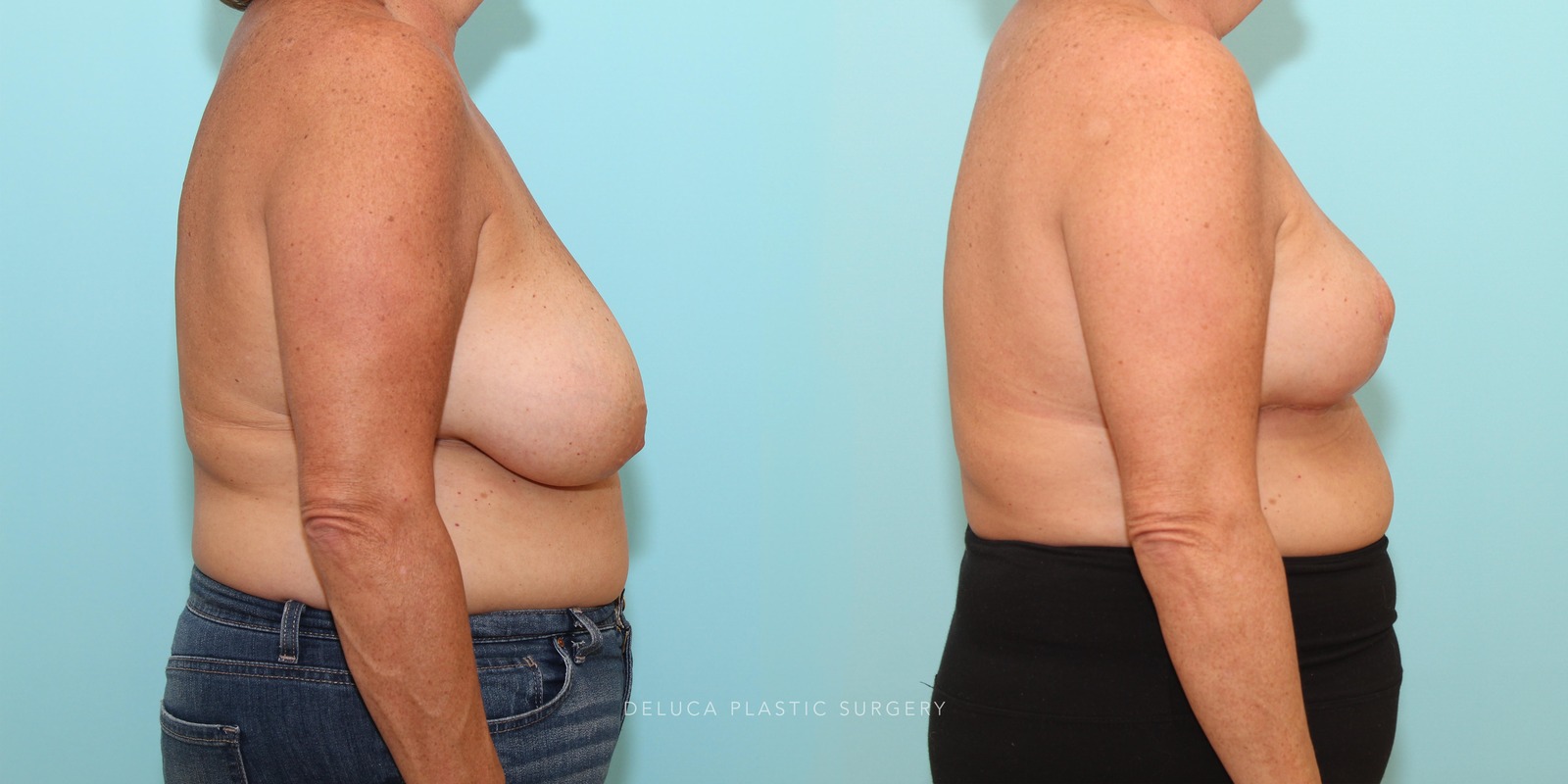 53 year old Inferior Pedicle, Wise Pattern Breast Reduction